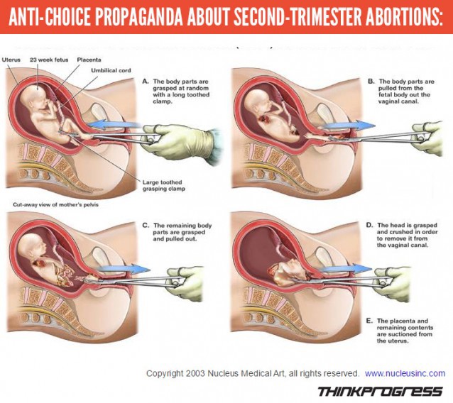 The illustrations of a D&E; procedure circulated on anti-abortion sites