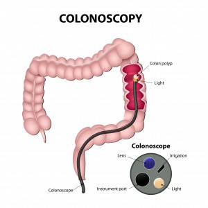 Tools used in routine colonoscopies CREDIT: Shutterstock
