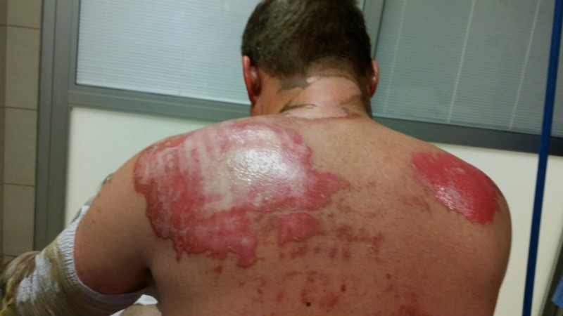 Cody Murray received burns on his back, face, and arms after an explosion near his well. CREDIT: Courtesy Murray family