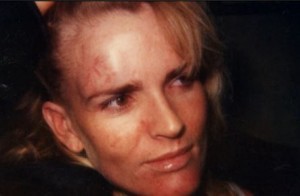 A polaroid of Nicole’s bruises from Jan 1, 1989. CREDIT: OJ: Made In America, Episode 2; Screencap