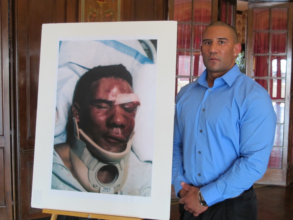 Frank Jude, Jr., stands next to a hospital photograph taken after drunken off-duty cops beat the hell out of him in 2004. CREDIT: AP Photo/Dinesh Ramde
