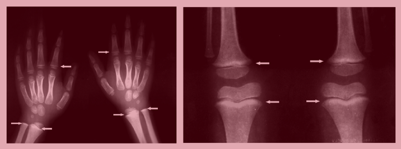 Majority of lead is stored in the bones, appearing as high sedimented strips. Photo courtesy of Dr. Celsa Lopez, Clinical Epidemiologic Research Unit, IMSS, Torreon, Mexico
