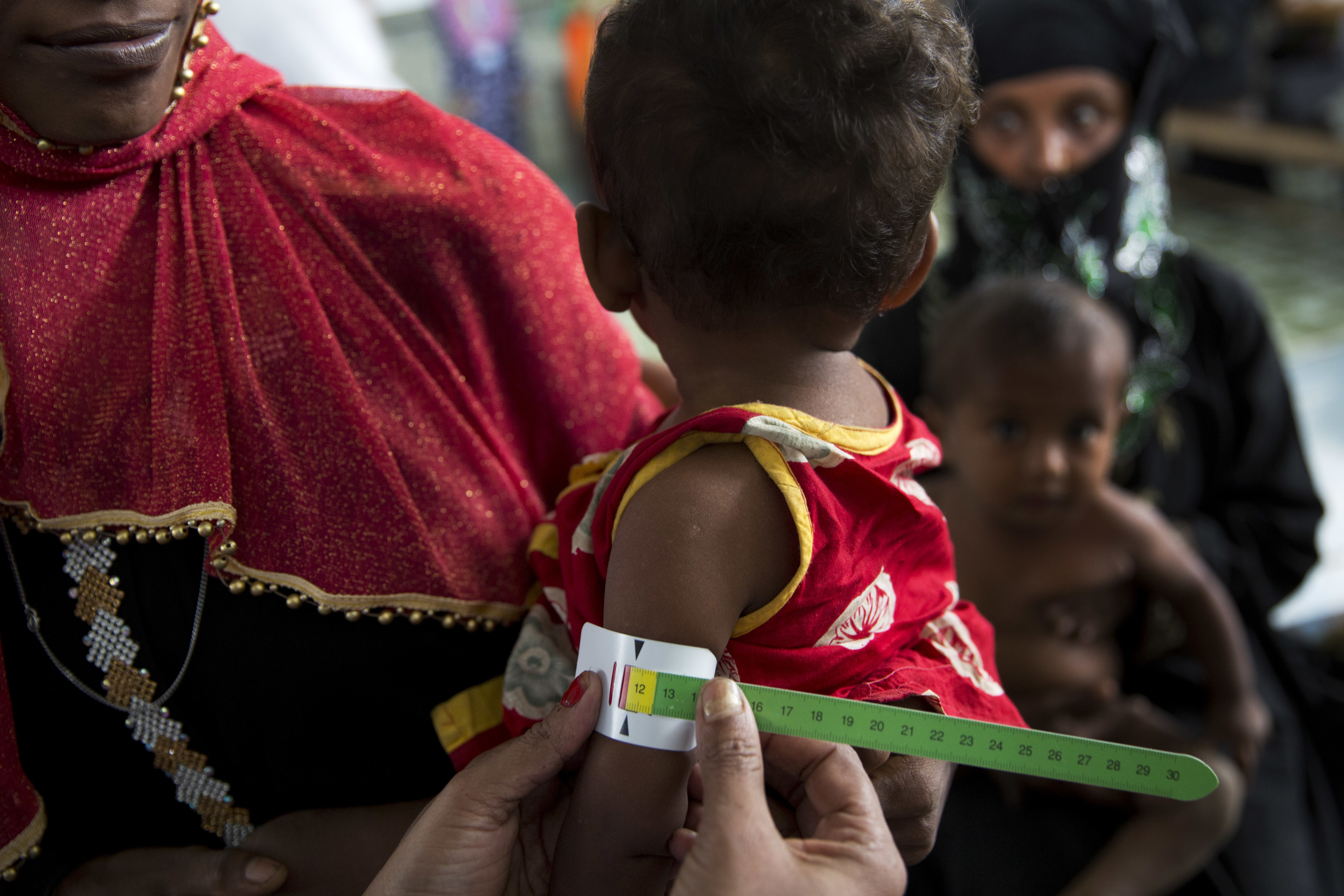A Rohingya refugee child suffering from malnutrition gets his arm measured at the Out Patient Therapeutic ward at Action contre La Faim (ACF) center in Kutupalong, Bangladesh, Monday, Oct. 30, 2017. CREDIT: Bernat Armangue/AP Photo